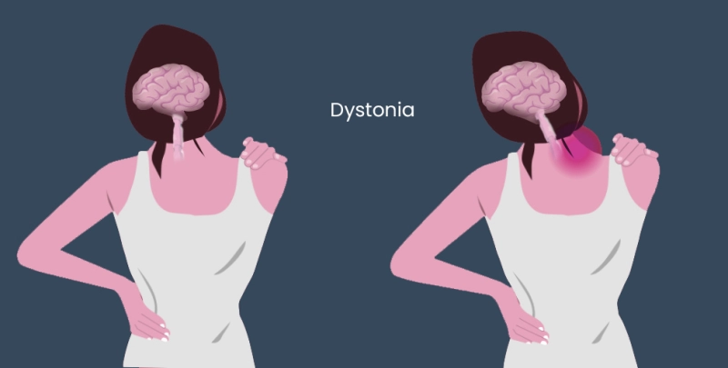 Dystonia