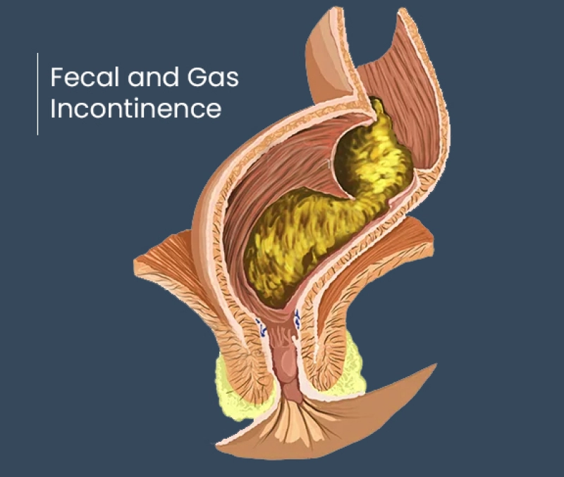 Fecal Incontinence